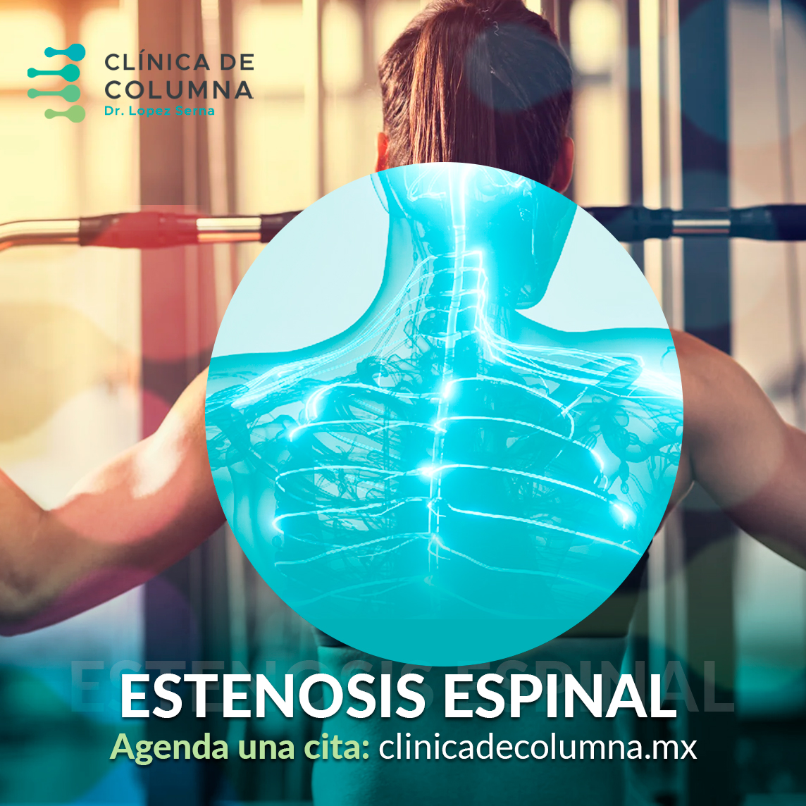 estenosis espinal en Cancún